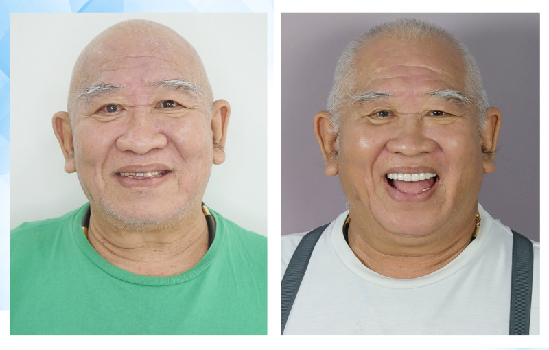 Trồng răng Implant - Bí quyết lựa chọn nha khoa uy tín cho người cao tuổi